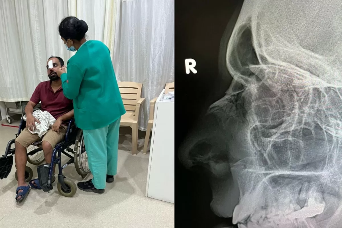 Delivery Agent Breaks Customer’s Nose After Row Over Address Mix-Up In Bengaluru